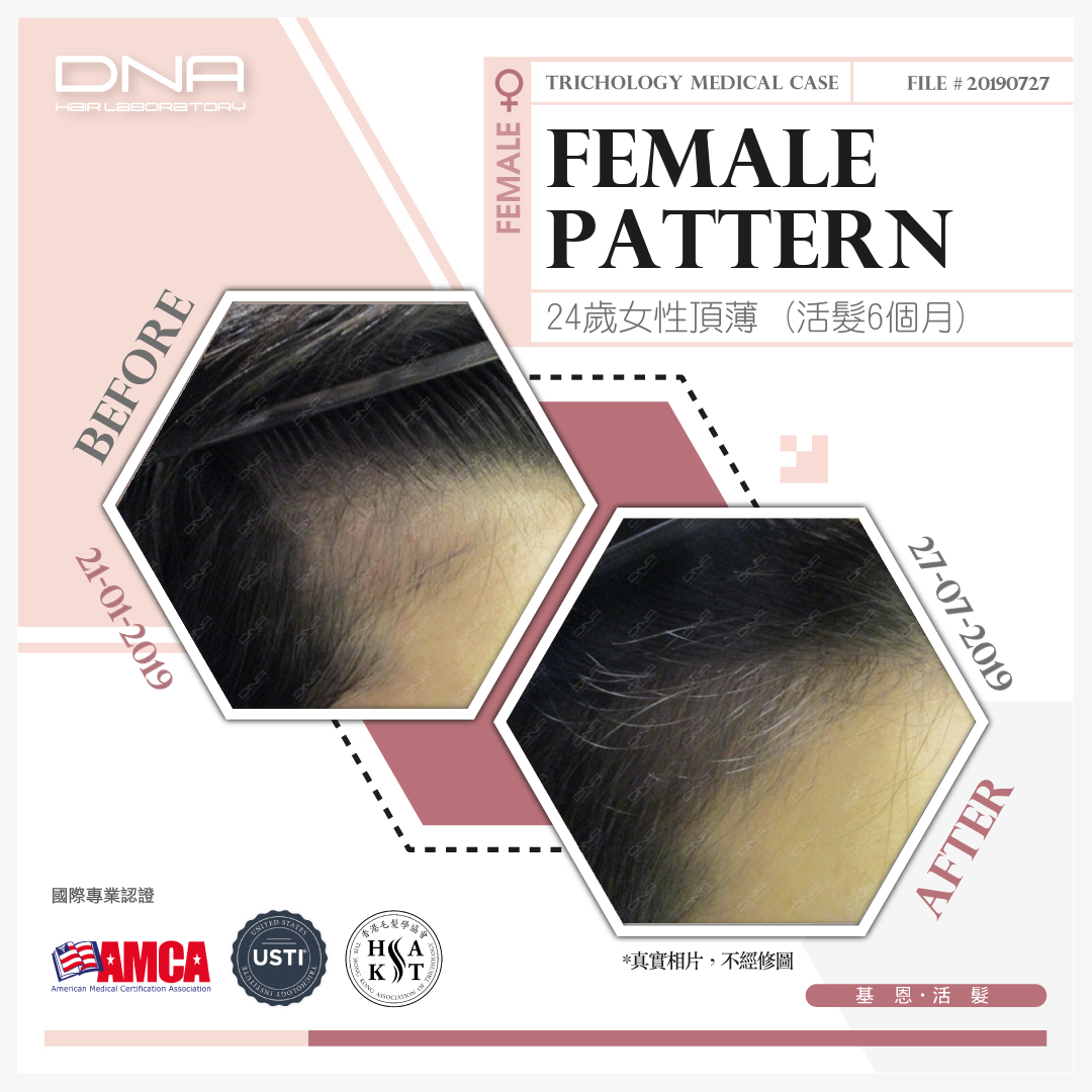 24-Year-Old Woman Experienced Widening Hairline and Significant Front Hair Loss Due to Medication
