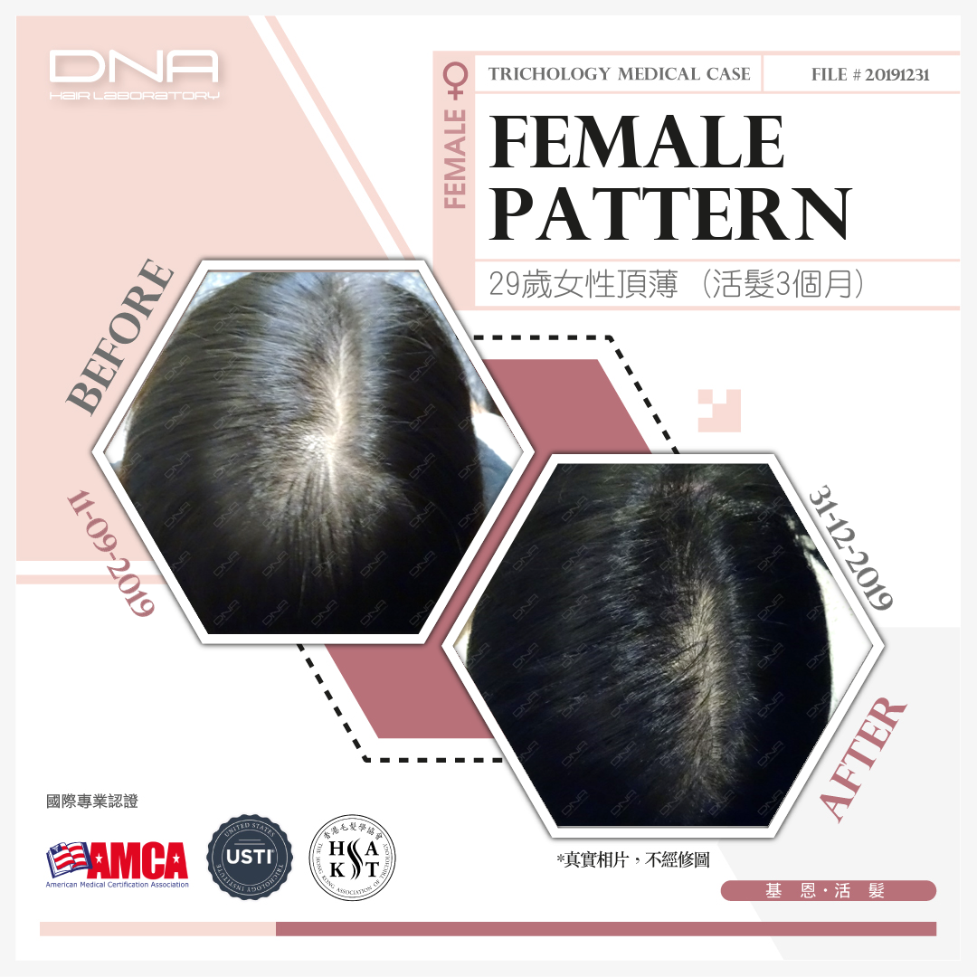 Female Teacher’s Improper Hair Product Use Led to Thinning – 3-Month Restoration Showed Improvement