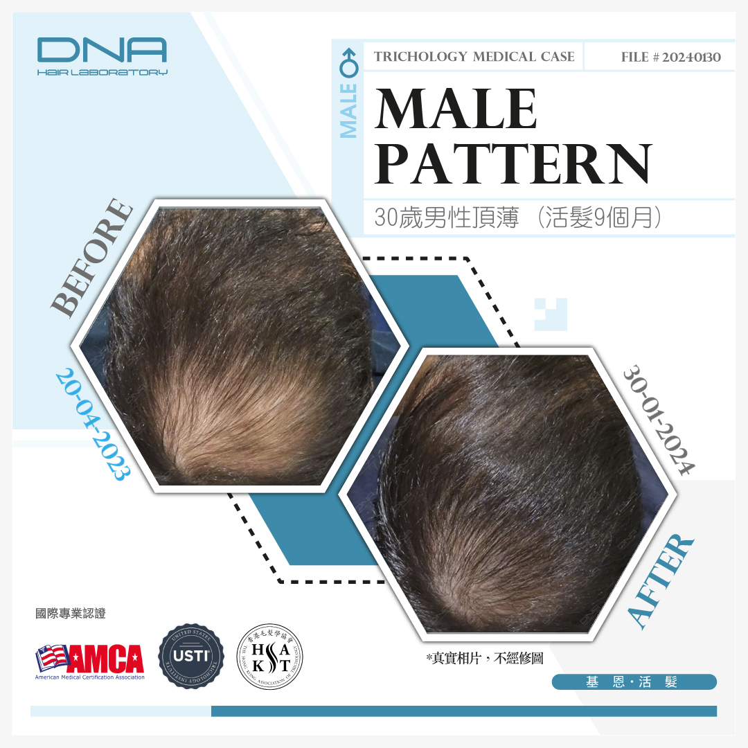 A 30-year-old foreign construction manager restores Hair After 9 months treatment