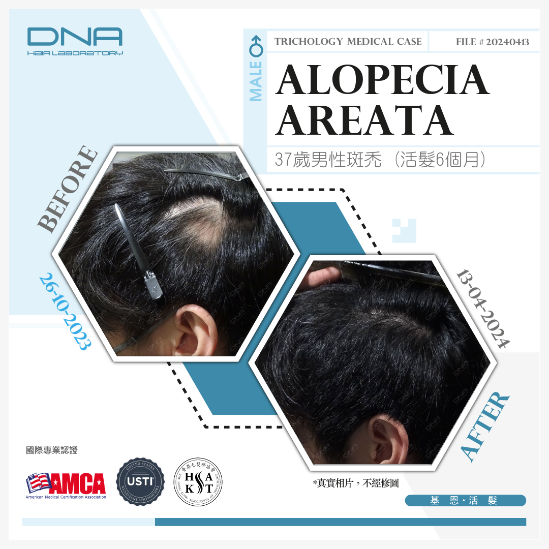 37-year-old male with alopecia areata fully recovered after 6 months of hair restoration treatment.