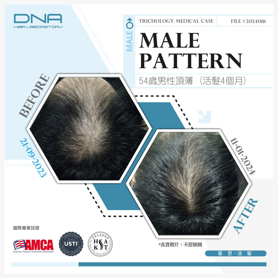 Men 50+ experience increased top hair loss with age; 4 months of hair growth treatment improves thin
