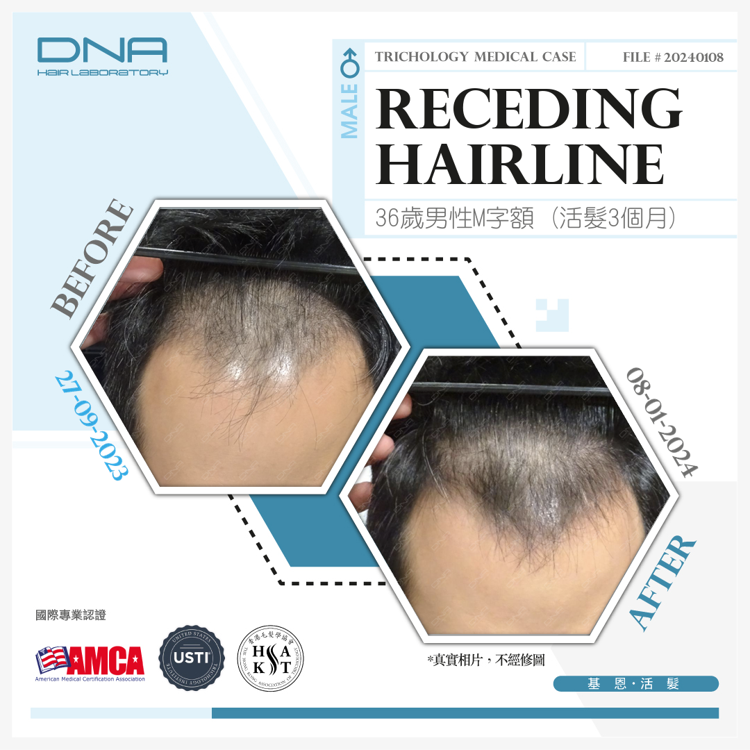 36-Year-Old Man Sees M-Shaped Hairline Improve in 3 Months