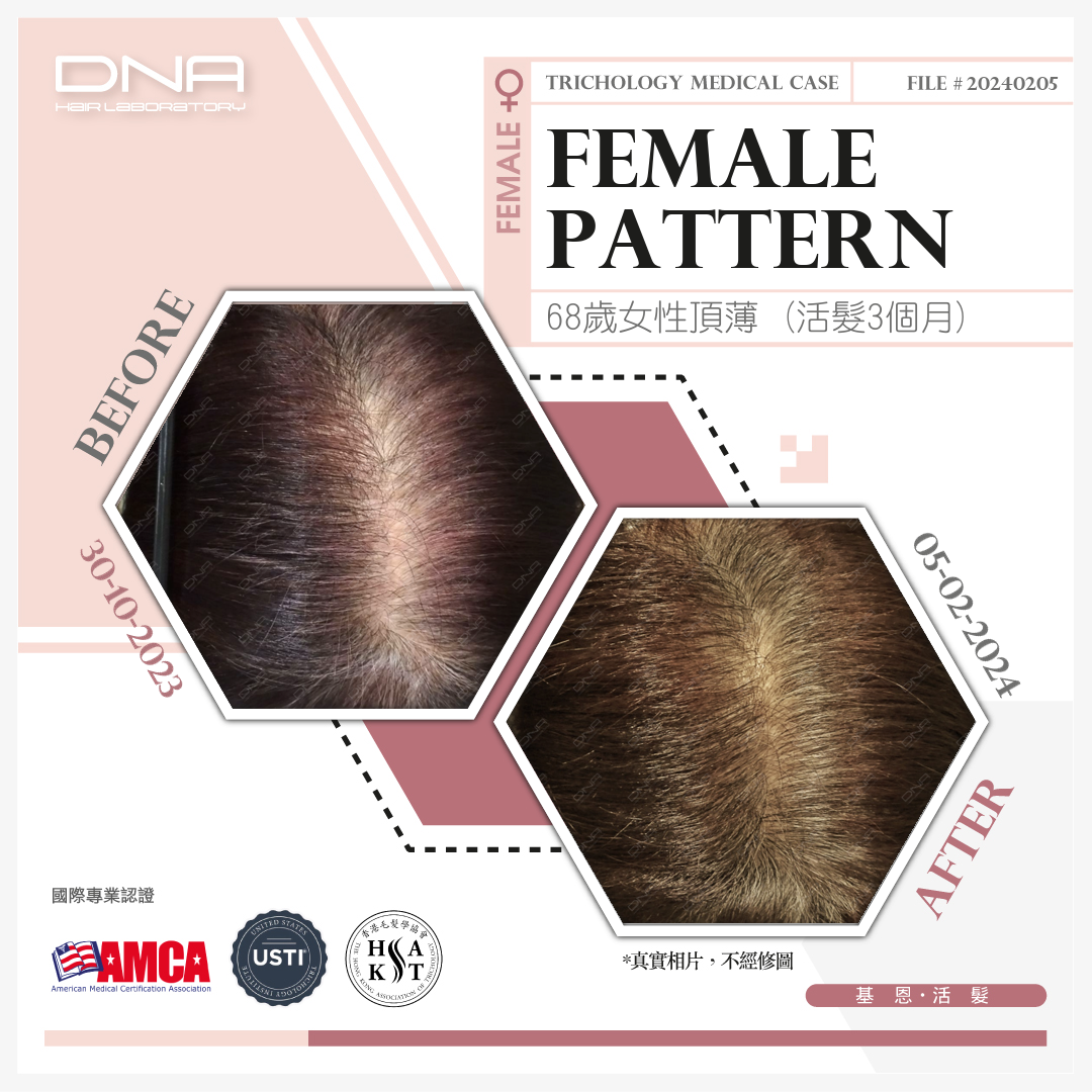 A 68-year-old woman improved hair loss in just 3 months – age doesn’t have to mean losing your hair.