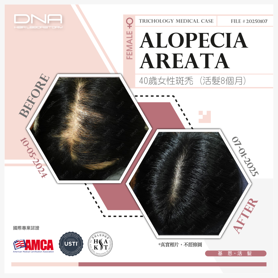 40-Year-Old Woman Recovers from Severe Alopecia Areata After 8 Months of Hair Regrowth Therapy